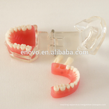 China Medical Anatomical Model Removable Soft Gingiva Standard Dental Jaw Model 13017